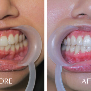 Dental-Cosmetic-Treatment-Before-and-After