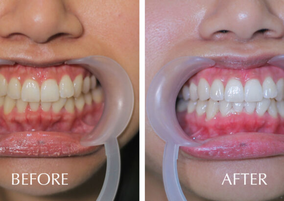 Dental-Cosmetic-Treatment-Before-and-After
