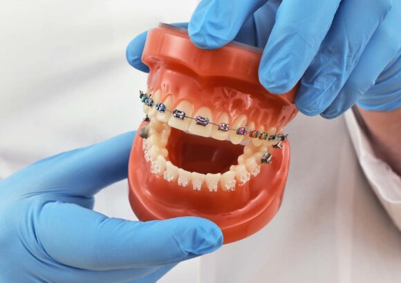 Orthodontic Treatment