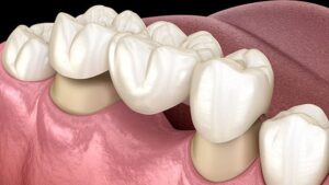 dental crowns