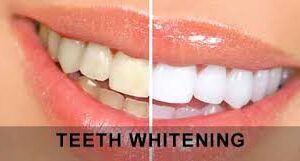 teeth whitening