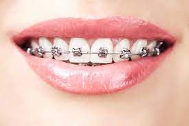 Types of Braces