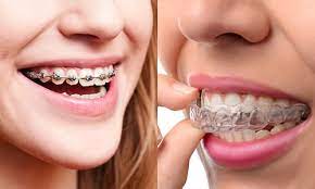 cosmetic dentistry: braces and aligners 