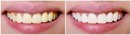 cosmetic dentistry: tooth whitening 