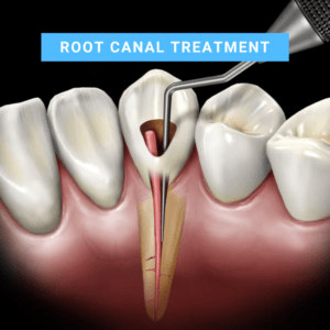 Root canal treatment