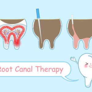 7 benefits of root canal