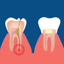 Root canal treatment