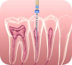 when to have root canal