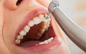 Teeth Cleaning services