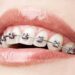 Orthodontic treatment: beyond braces