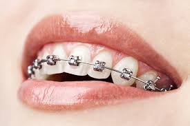 Orthodontic treatment: beyond braces