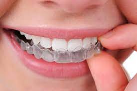 Orthodontic solutions: clear aligners