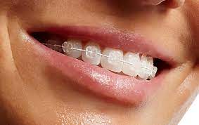 Orthodontic solutions: ceramic braces 