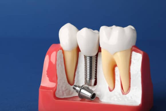 Tooth Replacement Cost in Kenya - Nairobi Sterling Dental Clinic | 0762