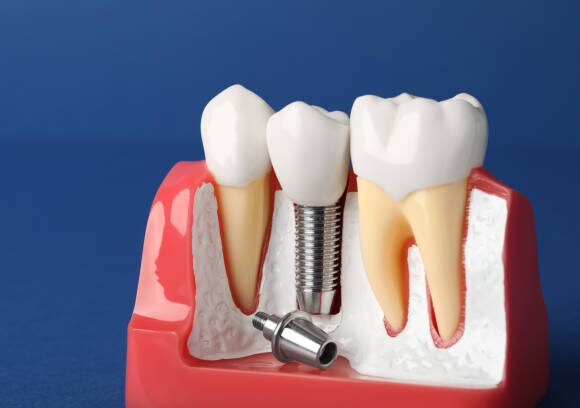 tooth replacement