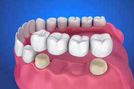Dental bridges