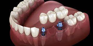 Tooth replacement : Dental Bridges 