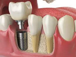 Tooth Replacement : Dental Implant