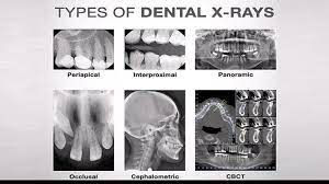 What Is a Dental X-Ray? Here's What You Need to Know