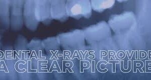 X-Rays For Your Smile: Understanding the Importance of Dental X-Rays