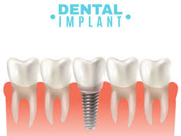 reasons why you need dental implants