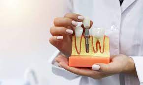 Choosing the Right Tooth Implants Dentist