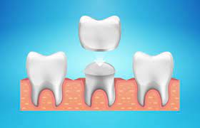 Is Your Smile Giving You the Blues? Affordable Dental Crowns in a Comfortable Setting