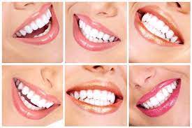 Dental Crowns Are a Secret of Hollywood Stars If You Ask The Correct Dentist: Getting Dental Crowns and the Benefits