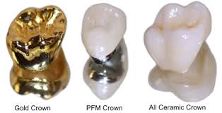 Dental Crowns Are a Secret of Hollywood Stars If You Ask The Correct Dentist: Getting Dental Crowns and the Benefits
