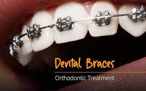 Understand Cost of Braces