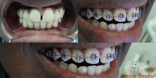 Dental Braces in Nairobi
