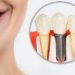Excellence in Dental Implants