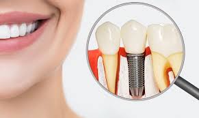 Excellence in Dental Implants