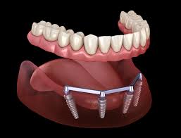 Exploring the Best Dental Implants Near Me