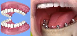 Full-Mouth Dental Implants