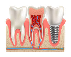 Excellence in Dental Implants