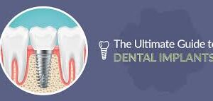 The Ultimate Guide to Tooth Implants