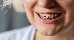 A Guide to Braces and Their Costs