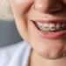 A Guide to Braces and Their Costs