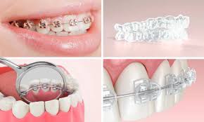 A Guide to Braces and Their Costs