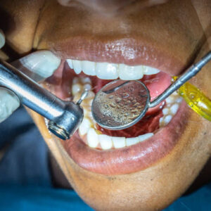Dental Fillings Cost