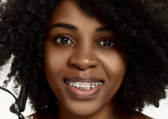 Cost of Dental Braces in Nairobi: What to Expect in 2025