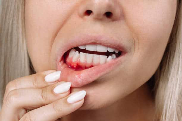 Why Your Gums Bleed When You Brush, And What To Do About It.
