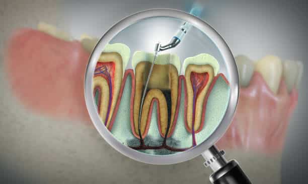 Root Canal Treatment: Busting the Myths and Fears