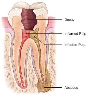 7 Signs You Might Need a Root Canal, And Why You Shouldn't Wait