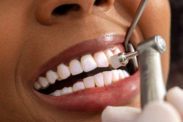 What Actually Happens During a Professional Teeth Cleaning β A Step-by-Step Guide