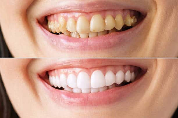 What Actually Happens During a Professional Teeth Cleaning β A Step-by-Step Guide